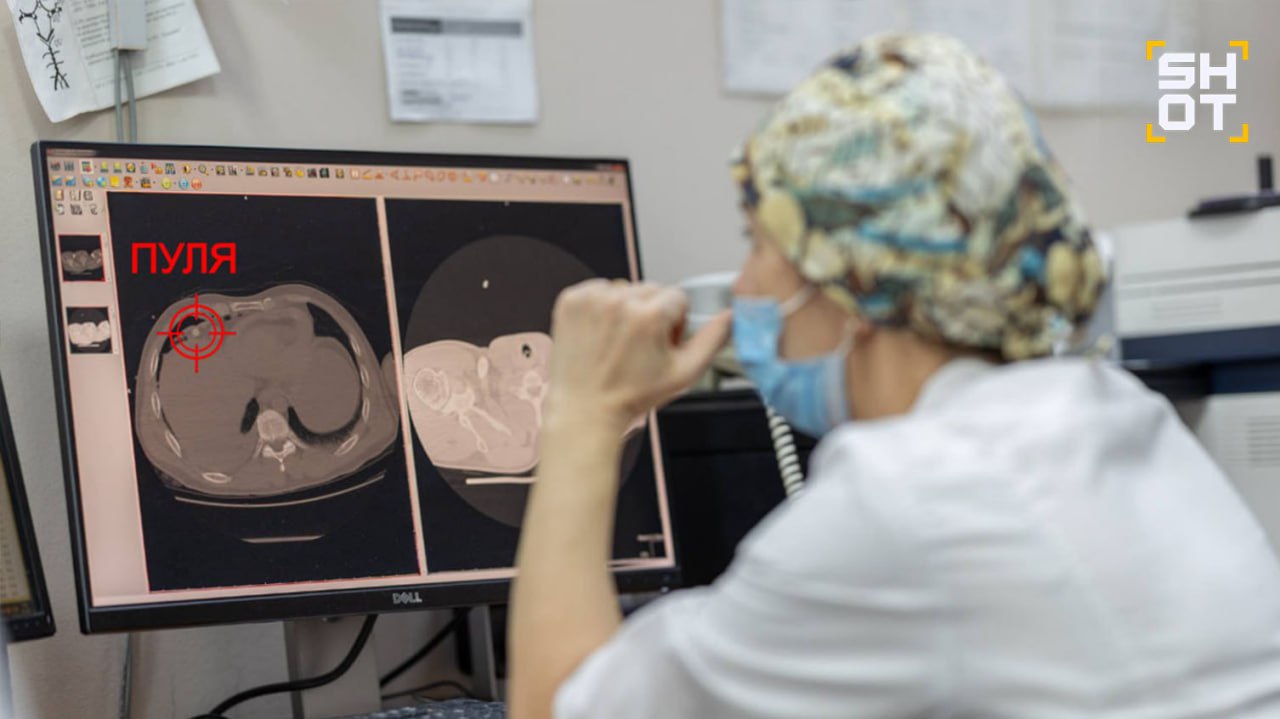 Уралец с огнестрелом в сердце восстал из мёртвых врачи воскресили мужчину который почти час пробыл в состоянии клинической смерти Как рассказали SHOT в Свердловском Минздраве врачи ЦГКБ 23 в Екатеринбурге спасли жизнь мужчине со сложнейшим пулевым ранением в сердце Всего в пострадавшем было три пули Одна из них сломала ребро и застряла в грудной клетке задев часть сердца У бедняги скопилась кровь в сердечной сумке перикарде и между лёгким и грудной стенкой Также ему диагностировали контузию лёгкого Хирургам пришлось вскрыть грудную клетку чтобы оперативно извлечь пулю У пациента дважды останавливалось сердце Врачи виртуозы запускали его непосредственно своими руками в стерильных условиях ритмично сжимали сердце в раскрытой грудной клетке до тех пор пока оно снова не начало биться В общей сложности мужчина провёл в состоянии клинической смерти 38 минут но медики смогли сохранить ему жизнь Они ушили рану сердца и перелили пациенту 1 5 литра донорской крови Девять дней пациент провёл в реанимации на ИВЛ перешёл в обычную палату и сейчас восстанавливается Подписывайся на SHOT Прислать новость