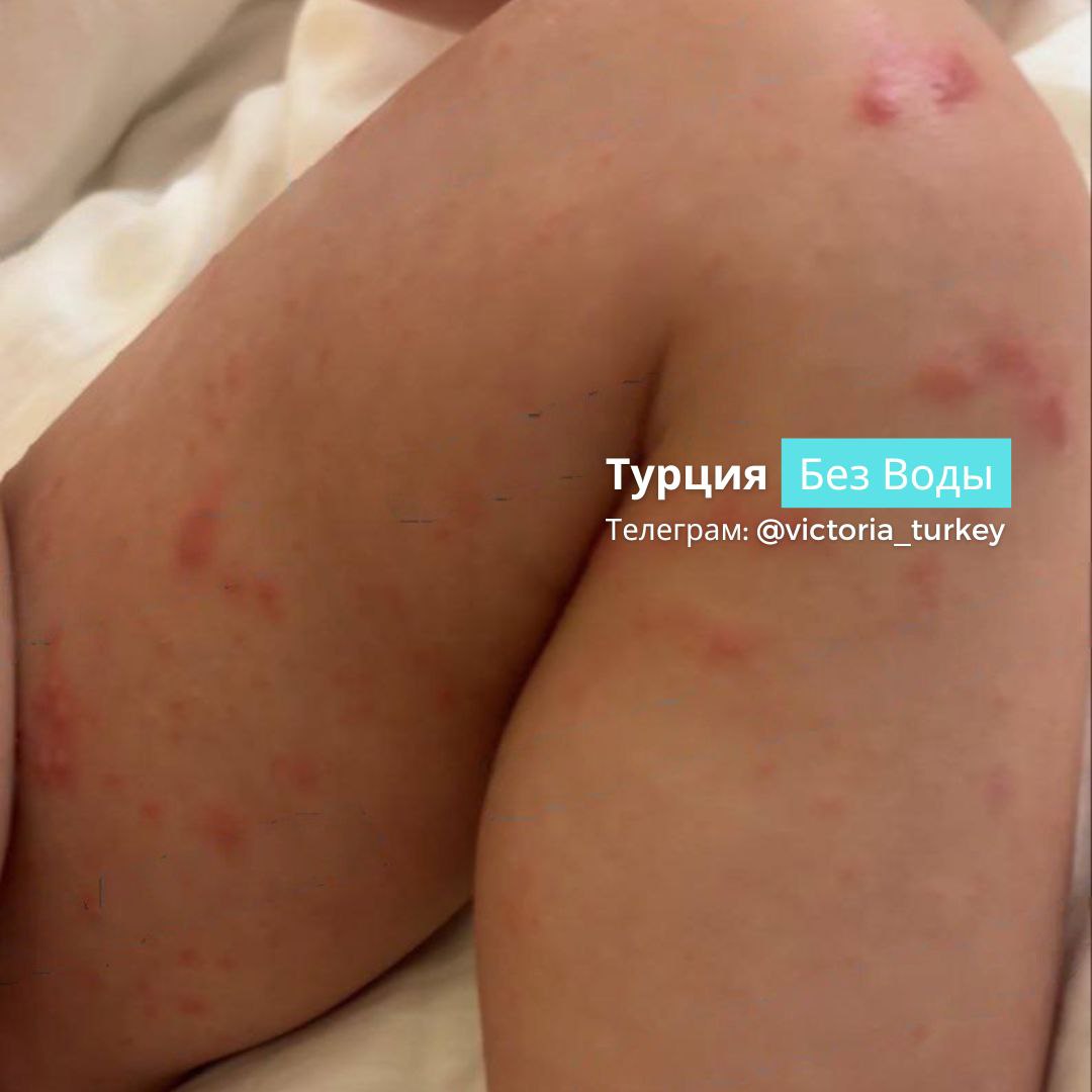 Вспышка Коксаки среди туристов: власти Антальи прокомментировали информацию #новоститурции В Анталье прокомментировали ранее появившуюся в соцсетях информацию о том, что в курортном регионе "гуляет" вирус Коксаки и им заражены российские туристы. Согласно заявлению муниципалитета Антальи, в настоящее время информации о вспышке вируса Коксаки среди российских отдыхающих, нет. Ранее о том, что в отеле Sunlight resort в Анталье среди отдыхающих зафиксирована вспышка вируса Коксаки, написал ряд Telegram-каналов. По их данным, в курортном отеле заболели около 15 туристов из Москвы, часть из них дети фото отправлено одним из туристов . "У нас нет сведений по этому поводу. Если бы была серьезная ситуация, отели в регионах сразу же сообщили нам об этом. Мы постоянно держим связь с ними отелями ", - заявили в муниципалитете Антальи. В минздраве Турции пообещали прояснить вопрос в ближайшее время.