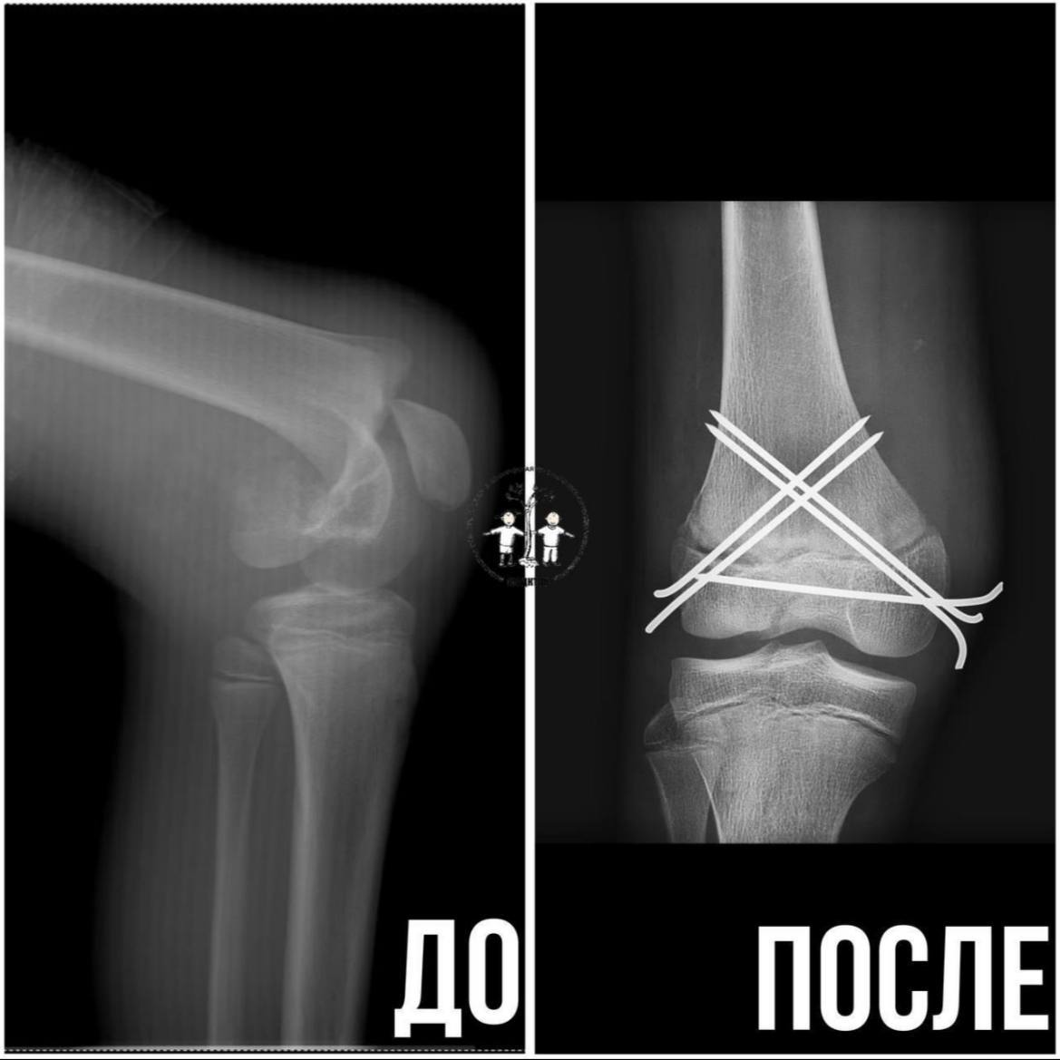 В Подмосковье врачи спасли ногу 16 летнему мотоциклисту который попал в аварию из за заклинившей педали газа После падения на бетонную плиту его экстренно доставили в больницу с переломом бедренной кости Врачи провели операцию восстановив положение отломков и закрепив их специальной конструкцией Сейчас подросток чувствует себя удовлетворительно через полгода ему снимут гипс и он вернется к полноценной жизни   Москва Главное