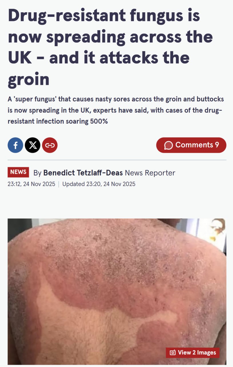 В Европе началось массовое распространение супергрибка который поражает пах и ягодицы Резкий рост заражения инфекцией trichophyton indotineae зафиксировали в Великобритании и Ирландии Болячка вызывает ужасные зудящие высыпания на коже В основном с паху на бёдрах и ягодицах Инфекция крайне заразная передаётся через кожный контакт но также может распространяться через прикосновение к зараженным поверхностям предметам домашнего обихода или половым путем Самое тревожное что она тяжело поддаётся лечению больные неделями не выходят из дома из за высыпаний Берегите себя и своих близких