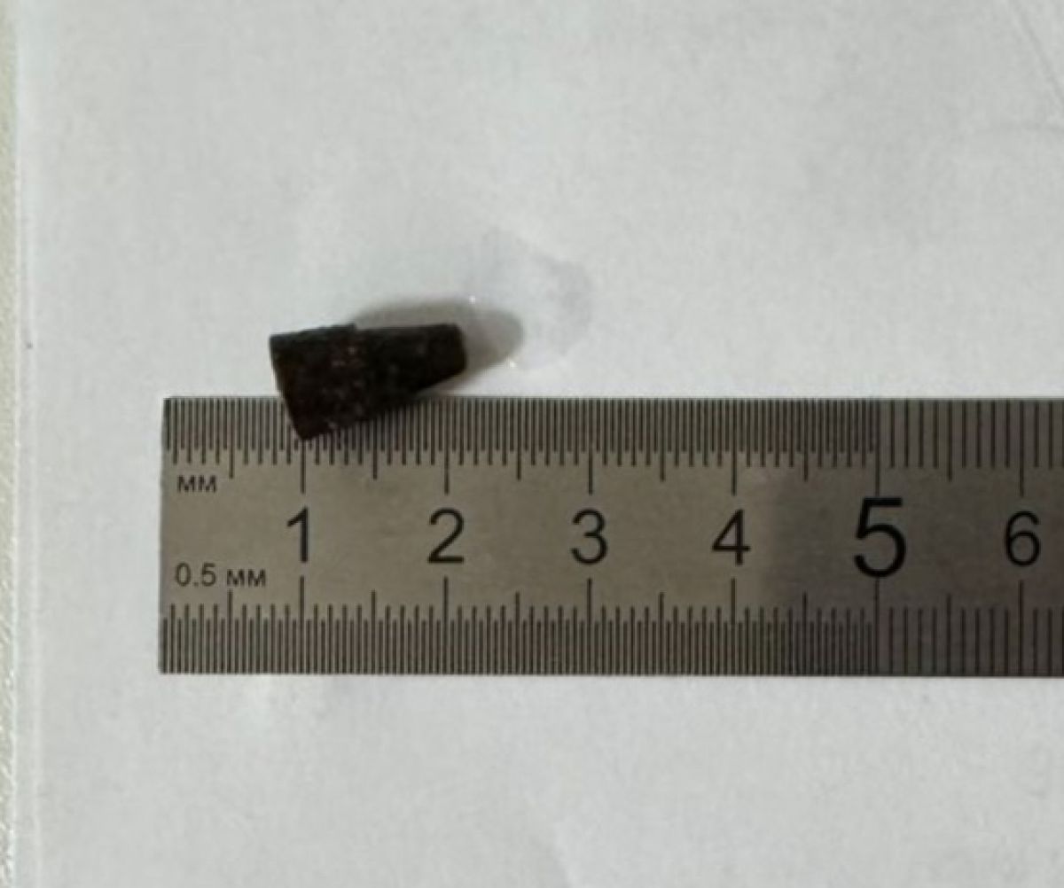 Во Владимире из лёгких пациента извлекли наконечник от ручки который он вдохнул 14 лет назад   newsvladimir ru fn 1750003 html В ГКБ 5 города Владимира врач во время бронхоскопии извлёк из бронхов молодого человека наконечник от ручки который он вдохнул 14 лет назад Спустя годы у него развилась пневмония которая плохо поддавалась лечению При проведении МСКТ лёгких врачи обнаружили инородное тело в бронхах   Прислать новость Подписаться   Мы в MAX