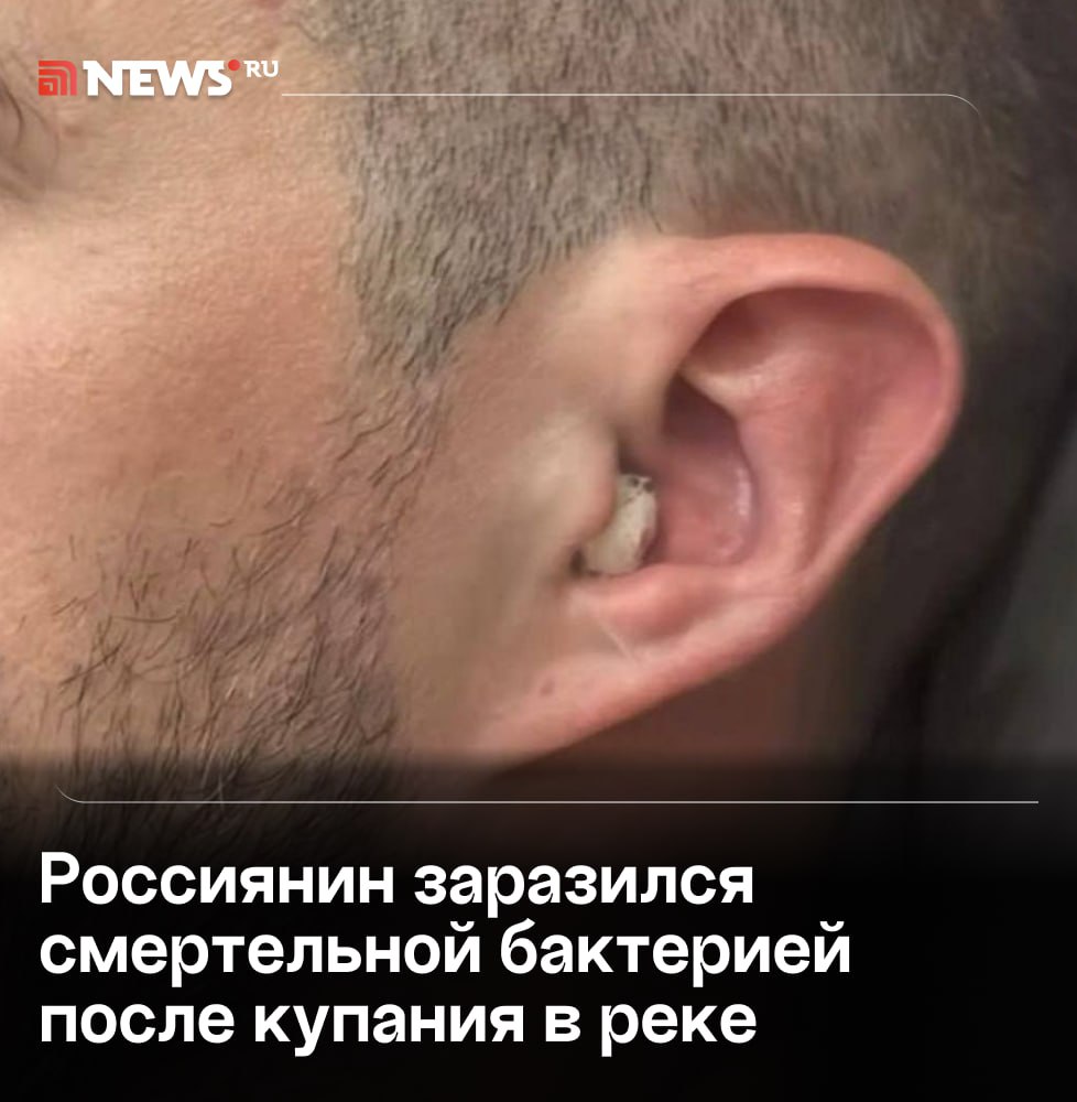 Россиянин потерял слух после купания в реке: мужчина подхватил смертельно опасную бактерию. У 35-летнего жителя Томска сразу после отдыха на одном из местных водоемов резко появилась сильная боль в ухе, образовалась гематома и поднялась температура, которую он не мог сбить десять дней. Врачи диагностировали заражение синегнойной палочкой — бактерия может привести к смерти и устойчива ко многим антибиотикам. Инфекция спровоцировала гнойный отит: Алексей почти две недели не слышал левым ухом. Подписаться Прислать новость Буст