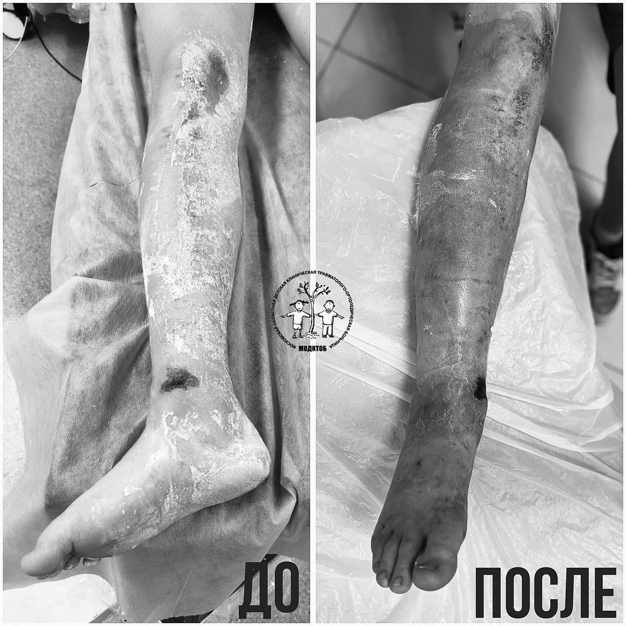 Подмосковные хирурги спасли подростка, пожалевшего лабрадора  Инцидент произошел на территории садового товарищества, когда парень, ехавший на велосипеде на большой скорости, пытался избежать столкновения с внезапно выбежавшим на дорогу лабрадором.  В результате подросток получил многооскольчатый перелом нижней трети костей голени — тяжелую травму для этого возраста. Медикам удалось выполнить сложную операцию по восстановлению анатомии голеностопного сустава минимально инвазивным методом, без больших разрезов.
