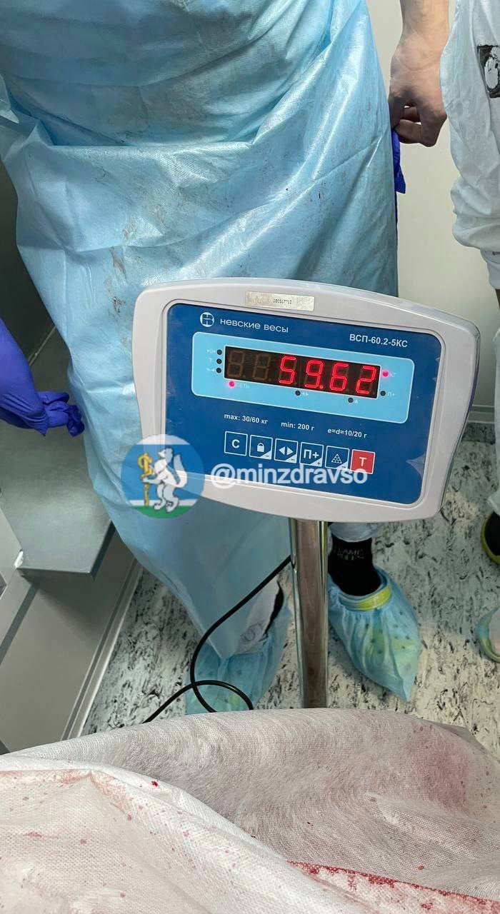 1  2  3  4  Гигантскую опухоль удалили врачи Свердловского областного онкологического диспансера у 50 летнего пациента Её вес больше 60 килограммов Живот мужчины рос около 20 лет не вызывая подозрений на опасность для жизни Липосаркома опухоль развивающаяся из жировой ткани находится вне органов поэтому крайне затруднительна для диагностики Операционная бригада из 8 человек спустя 7 часов 40 минут удалила гигантскую липосаркому Медики попробовали взвесить новообразование однако шкала весов ограничена 60 кг а вес опухоли превышал этот параметр Здоровье уральцев