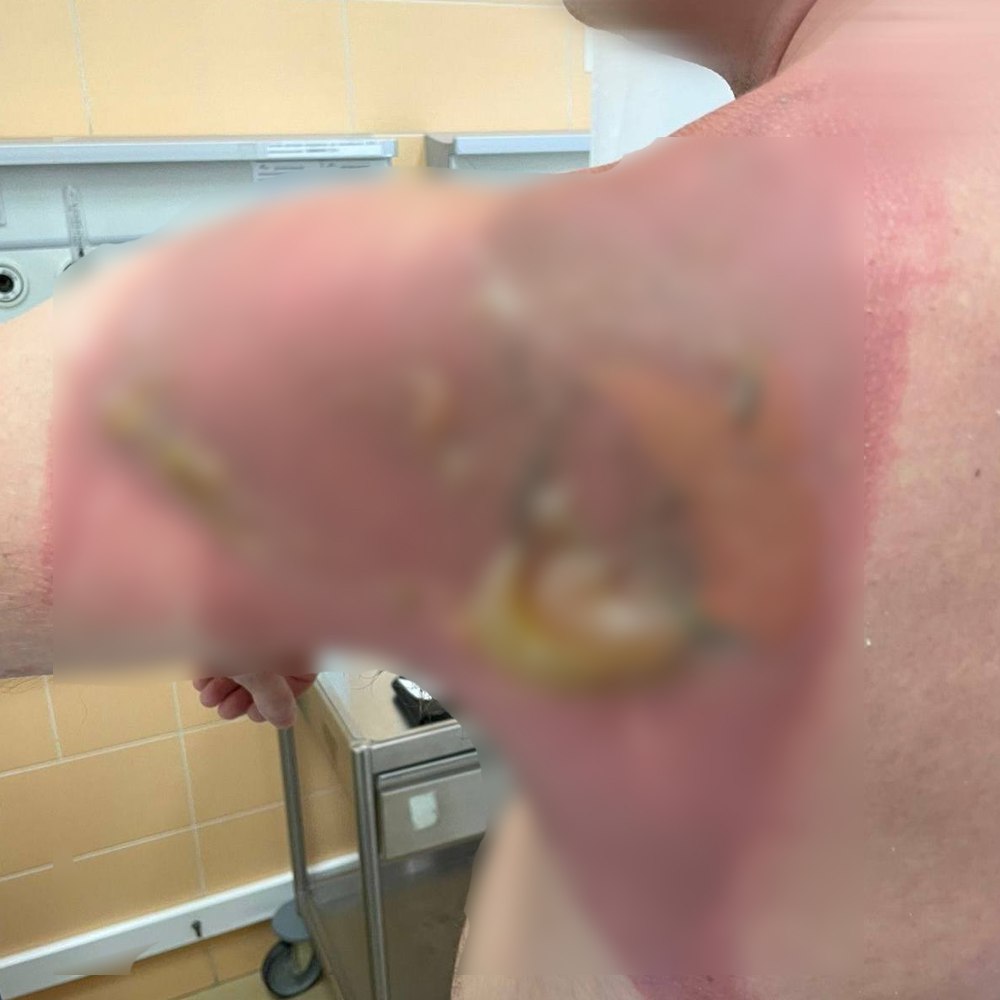 Казанец получил страшный ожог из за капсул для стирки Супруга мужчины постирала постельное белье с новыми капсулами из Азии которые купила на маркетплейсе а утром он проснулся уже с ожогом Врачи РКБ диагностировали у него химический ожог 1 2 степени После обработки раны пациента отпустили домой   Вечерка в MAX в Telegram