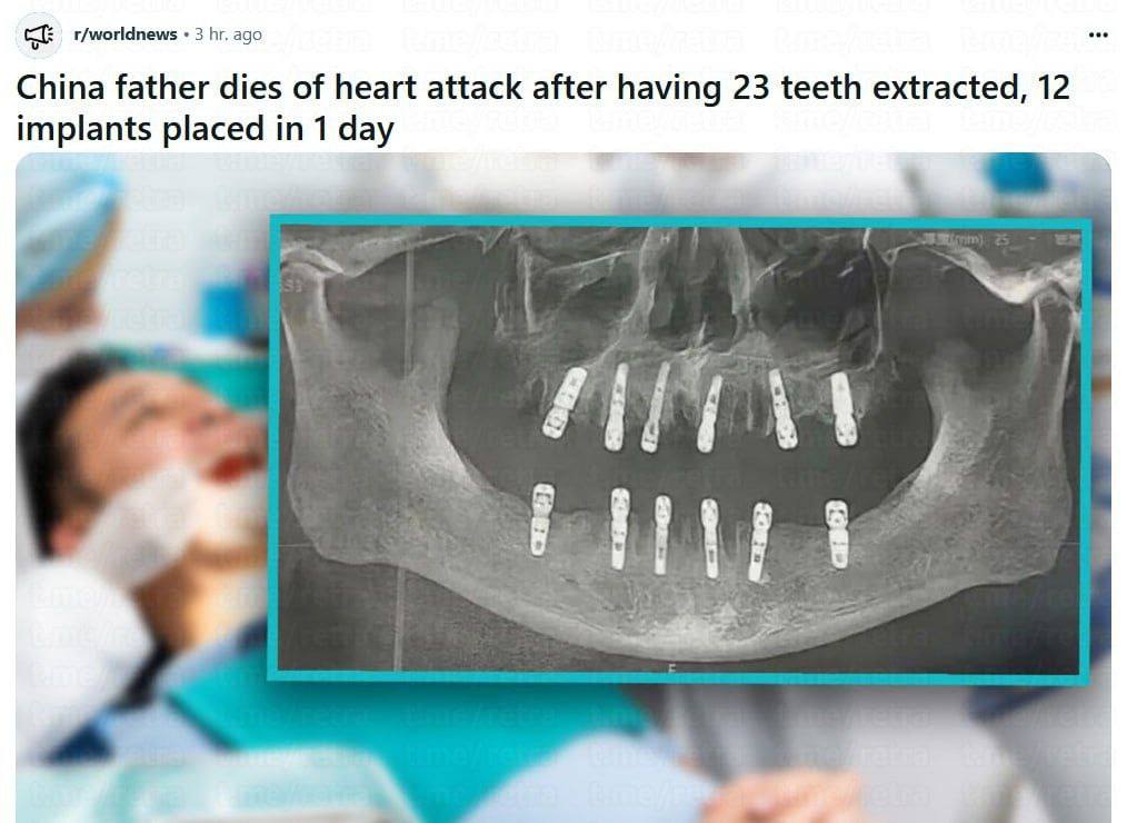 В Китае мужчина умер после того, как стоматолог вырвал ему 23 зуба и установил 12 имплантов за один приём.  Согласно документам, эта процедура называлась «Немедленная реставрация». После неё пациент мучался от постоянных болей, и через 13 дней скончался от остановки сердца.  #Новости #Китай #Стоматолог