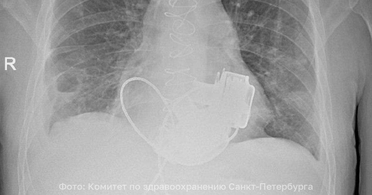Пульса нет вообще а вместо сердца два пламенных мотора в России впервые пациенту имплантировали оба желудочка В Санкт Петербурге врачи готовят к выписке пациента который теперь живёт без пульса В конце ноября 2025 года 36 летнему мужчине имплантировали одновременно левый и правый искусственные желудочки сердца Об этом рассказали в городском комитете по здравоохранению По словам главного врача Мариинской больницы Игоря Реутского когда Антон поступил в стационар показатели работы сердца были такими будто человек уже не жив а мёртв При этом из за сопутствующих осложнений трансплантация сердца была невозможна Операция продолжалась около 4 часов Для наших специалистов самым сложным было синхронизировать работу двух искусственных желудочков сердца но с этой задачей мы успешно справились Это доказывает высокий уровень развития кардиохирургии в нашем городе отметил главный внештатный специалист по сердечно сосудистой хирургии Санкт Петербурга Геннадий Хубулава