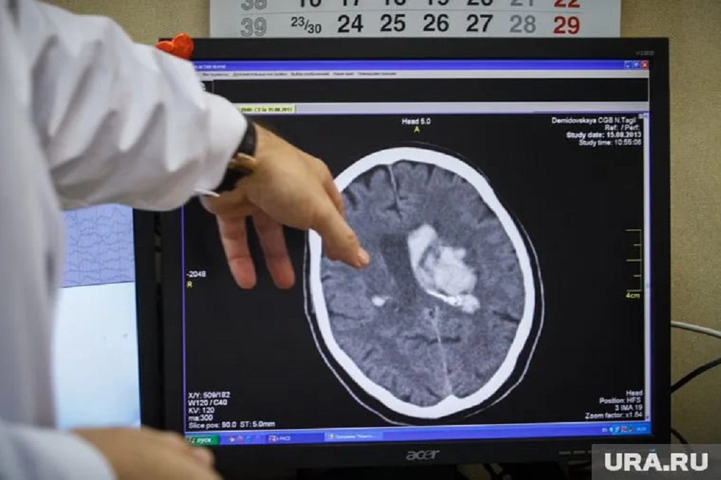 Соединение подавляющее агрессивную опухоль мозга нашли ученые Данные полученные Институтом химической биологии и фундаментальной медицины Сибирского отделения РАН можно использовать для поиска новых противоопухолевых препаратов способных блокировать распространение глиобластомы Это наиболее распространенная и крайне агрессивная опухоль головного мозга Даже при проведении полного курса лечения продолжительность жизни пациентов после постановки диагноза обычно не превышает 15 месяцев Фото Александр Мамаев URA RU