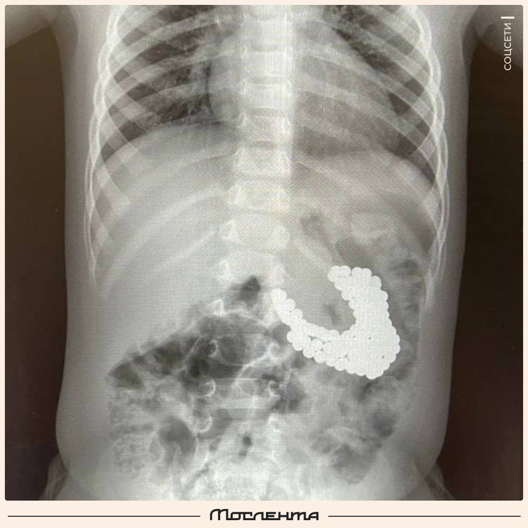 Подмосковные врачи спасли полуторагодовалого ребёнка, который проглотил 130 магнитов.  В детский центр поступил мальчик. Результаты УЗИ показали огромное количество магнитов и литиевую батарейку, которые слиплись все у него в желудке. Врачами было принято решение как можно скорее извлечь инородные предметы, чтобы не допустить ожогов и некроза тканей.  С помощью эндоскопа хирурги достали все магниты. Оказалось, что малыш глотал их в разное время, пока они не притянулись друг к другу и начали вызывать дискомфорт. Сейчас ребёнок чувствует себя хорошо и уже выписан