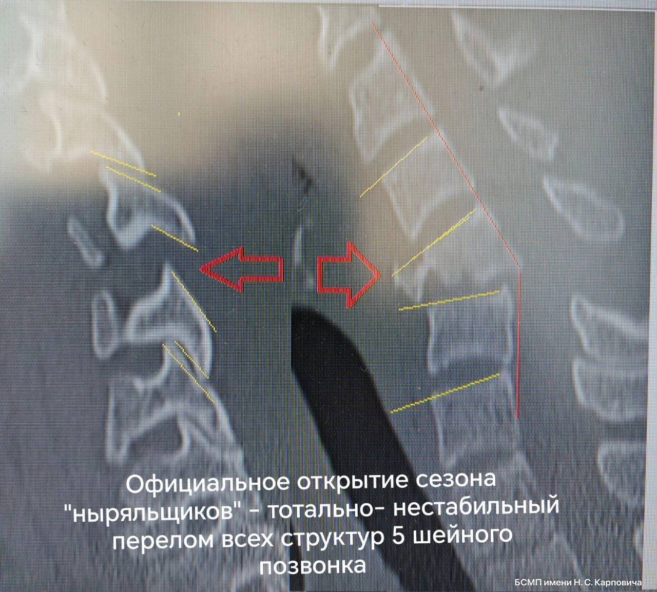 Сезон ныряльщиков: трое красноярцев сломали шеи из-за неудачных прыжков в воду и падения с турника Один из них поскользнулся и упал в воду, получив перелом и вывих пятого шейного позвонка. Другой нырнул и ударился головой, что привело к «растрескивающемуся» перелому первого шейного позвонка. Третий молодой человек повредил третий шейный позвонок, упав с турника. Об этих случаях рассказали в БСМП имени Н. С. Карповича. Всем пострадавшим выполнили стабилизацию позвоночника с применением металлоконструкций. Сейчас пациентов выписали домой на долечивание с ограничением подвижности шейного отдела с помощью специального корсета. _____ Оставить обращение