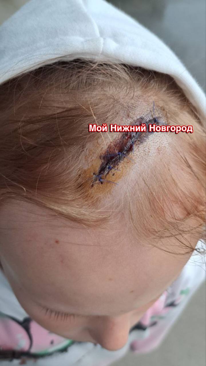 Гостеприимный Нижний — сухие ветки чуть не проломили голову ребенку в Александровском саду Туристы из Йошкар-Олы прогуливались по парку, когда им на головы посыпались ветки. Восьмилетняя девочка получила черепно-мозговую травму, рану пришлось зашивать. Семья хочет найти ответственных за состояние деревьев в парке и привлечь к ответственности за случившееся. Подпишись \ Предложи новость