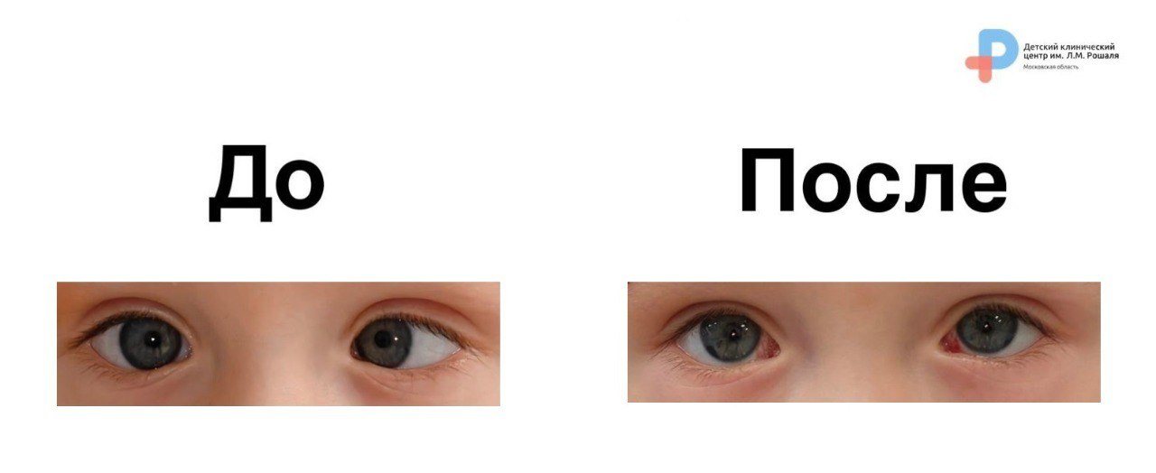 В детском клиническом центре имени Л М Рошаля успешно прооперировали ребенка с косоглазием В клинический центр поступил годовалый мальчик с врожденным сходящимся косоглазием угол отклонения которого составлял 30 градусов Обычно пациентам такого возраста рекомендуют консервативное лечение а операцию назначают не раньше 4 6 лет Однако специалисты центра приняли решение провести операцию по современной методике хемоденервации с использованием ботокса Этот метод позволяет не только устранить косметический дефект но и создать условия для правильного развития зрительных функций Заведующий отделением офтальмологии и микрохирургии глаза Максим Черников отметил что раннее выравнивание глаз может способствовать самостоятельному формированию бинокулярного зрения без длительного аппаратного лечения Операция прошла успешно и мальчик уже выписан из центра