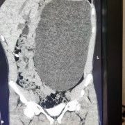 Почка с пятилитровую бутылку выросла у подростка в Новосибирске ему спас жизнь осмотр перед трудоустройством Так парню поставили диагноз гидронефроз Почка по словам врачей могла взорваться в любой момент При этом 17 летний подросток чувствовал себя здоровым Подписаться на РИА Новости