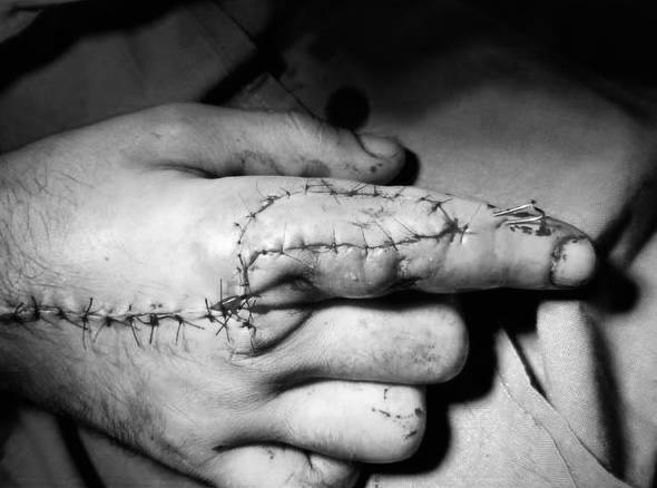 В Красногорске мужчина поранился когда собирал мебель и едва не лишился пальца Он поранил палец проволокой и подхватил инфекцию У пациента началось воспаление но врачи своевременно вмешались Сейчас он чувствует себя хорошо его уже выписали Радио 1 MAX Прислать новость