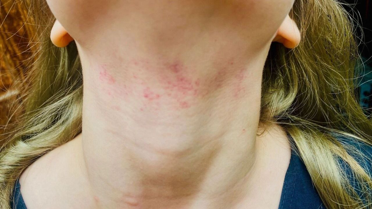 В школьном лагере под Тюменью 15-летняя девочка из коррекционной школы напала на 10-летнюю — начала душить её прямо в здании школы.    Пострадавшая пожаловалась маме на боль в шее, дома у ребёнка обнаружили гематомы. Инцидент произошёл 4 июля в лагере при Тоболовской школе.    Родители утверждают, что нападавшая держит в страхе других детей, а администрация бездействует. Семья уже обратилась в полицию.   ‍  В УМВД подтвердили, что проводят проверку. После выяснения всех обстоятельств пообещали принять меры.    Присылай новости