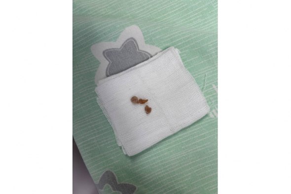 В Иркутске врачи удалили кусочек арахиса из легкого годовалого ребенка Хирурги экстренно провели эндоскопическую операцию Читать подробнее на сайте