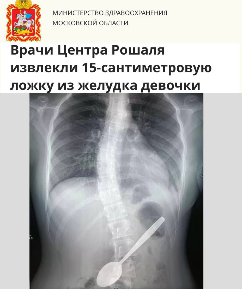 Невероятный случай в медицине: из желудка школьницы извлекли 15-сантиметровую ложку В Детский клинический центр имени Л. М. Рошаля обратилась 14-летняя девочка с необычной проблемой: она проглотила столовую ложку, пытаясь извлечь застрявший в горле кусок яблока. • Врачи провели рентгенографию брюшной полости и обнаружили в желудке девочки инородное тело. • Девочка была немедленно госпитализирована для проведения операции. «Ложка находилась в желудке таким образом, что одним концом упиралась в стенку желудка, а другим достигала двенадцатиперстной кишки. С помощью эндоскопической петли ложку аккуратно переместили к глотке, а затем с использованием хирургического зажима полностью извлекли из организма», - поделилась деталями операции врач-эндоскопист Дарья Степаненко. Операция заняла около часа и завершилась успешно, не оставив за собой никаких осложнений для здоровья девочки.