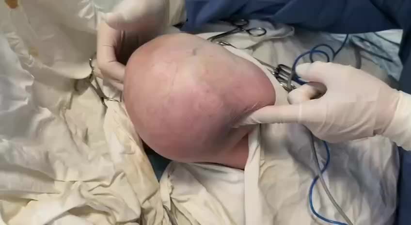 Успешное удаление гигантской липомы у 60-летней пациентки в Дагестане