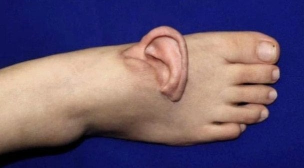 Китаянке пришили оторванное ухо на стопу Работница одной из фабрик получила страшную производственную травму в результате которой потеряла ухо Чтобы спасти орган его вживили в ногу Так пострадавшая проходила 5 месяцев пишет Оddity Сentral Сразу вернуть ухо на естественное место не удалось из за сильно поврежденных сосудов потому временно его пришили к верхней стороне стопы В этой области кожа такая же тонкая а кровеносные сосуды такого же диаметра как и в ухе что облегчило трансплантацию Чтобы улучшить кровообращение и восстановление женщине пришлось много ходить и носить открытую обувь Но все закончилось благополучно В октябре после долгой и сложной операции ухо вернули на место Подписаться на truekpru Читать нас в MAX