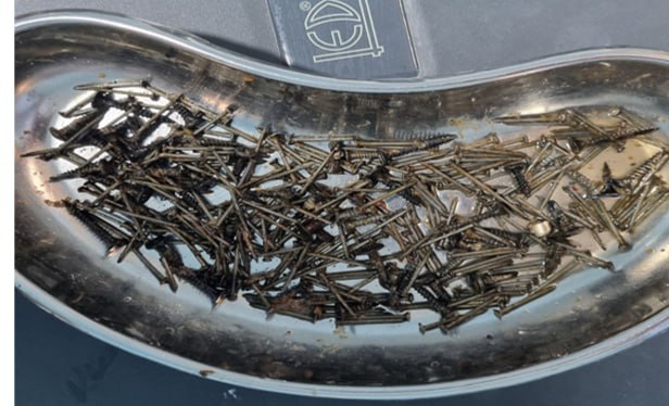 В Самаркандском филиале Республиканского научного центра экстренной медицинской помощи 29 летний мужчина с болями в животе был прооперирован из за большого количества гвоздей и саморезов в желудке которые он проглотил в состоянии стресса