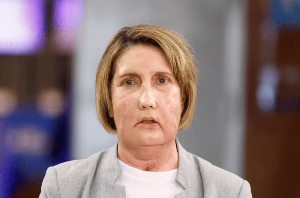 В Барселоне впервые в мире пересадили часть лица от донора после эвтаназии В Барселоне провели первую в мире пересадку части лица от донора ушедшего из жизни с помощью эвтаназии Операцию выполнили в больнице Vall d Hebron Летом 2024 года испанка Кармен оказалась в критическом состоянии после укуса насекомого на Канарских островах Инфекция развивалась стремительно она потеряла часть лица не могла есть и говорить Донором стала женщина с неизлечимым заболеванием которая перед эвтаназией согласилась пожертвовать органы включая лицо Операция длилась 15 часов в ней участвовали более 100 специалистов использовались 3D модели Уже через месяц пациентка смогла самостоятельно есть и говорить Случай рассматривают как важный шаг в развитии трансплантологии в Испании Наука Здоровье Барселона   russpain com news v barselone proveli unikalnuju operaciju lico peresadili posle evtanazii 382815