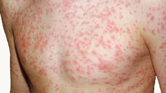 Возможные новые случаи заболевания корью: власти ожидают результаты анализов Три случая с подозрением на корь зафиксированы на прошлой неделе в муниципии Кишинев. Об этом сообщил заместитель начальника Управления здравоохранения Владимир Болокан, пишет Rupor. «Ожидаем результатов лабораторных исследований. В остальном ситуация с другими сезонными заболеваниями и инфекциями под контролем, никаких чрезвычайных случаев нет» , — заявил Болокан. На том же заседании мэрии Кишинева он также отметил, что в городских больницах зарегистрировано незначительное увеличение случаев респираторных инфекций, что временно привело к «перегрузке коек в пульмонологических отделениях для взрослых». Берегите себя и своих близких…