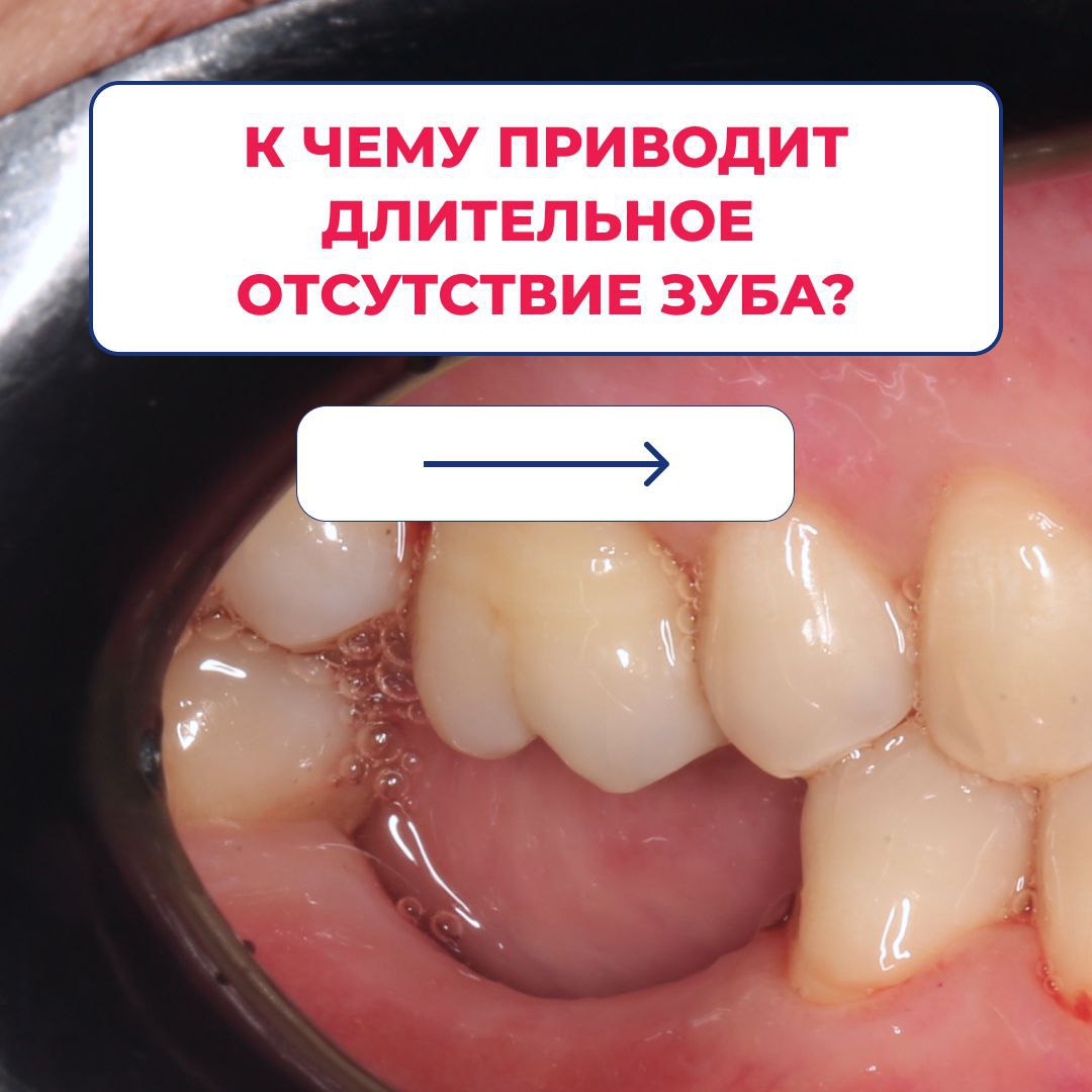 Уже долгое время у пациента отсутствовали два жевательных зуба на нижней челюсти. Это привело к неизбежным последствиям.   Восьмой зуб сместился в сторону пустоты.   Десна начала убывать, образовался выраженный провал.   Противоположный зуб на верхней челюсти выдвинулся в сторону пустоты. Из-за этого оголилась шейка зуба и у пациента возникала сильная боль в этой области.  Проблему сначала решали хирургическим путем.   Зуб мудрости удалили   На место шестого и седьмого зуба установили импланты   Мягкие ткани восстановили с помощью десневого трансплантата  Через 2,5 месяца сняли слепки и изготовили временные коронки на импланты. Далее пациенту предстоит пройти частичное ортодонтическое лечение — требуется вернуть верхнюю «шестерку» на место. Когда прикус будет правильным, пациенту установят постоянные керамические коронки.  Если вам пришлось удалить зуб, то его нужно как можно скорее восстановить имплантом. Тогда возможно удастся избежать дополнительного лечения.  У вас есть долго отсутствующие зубы? Видите последствия?