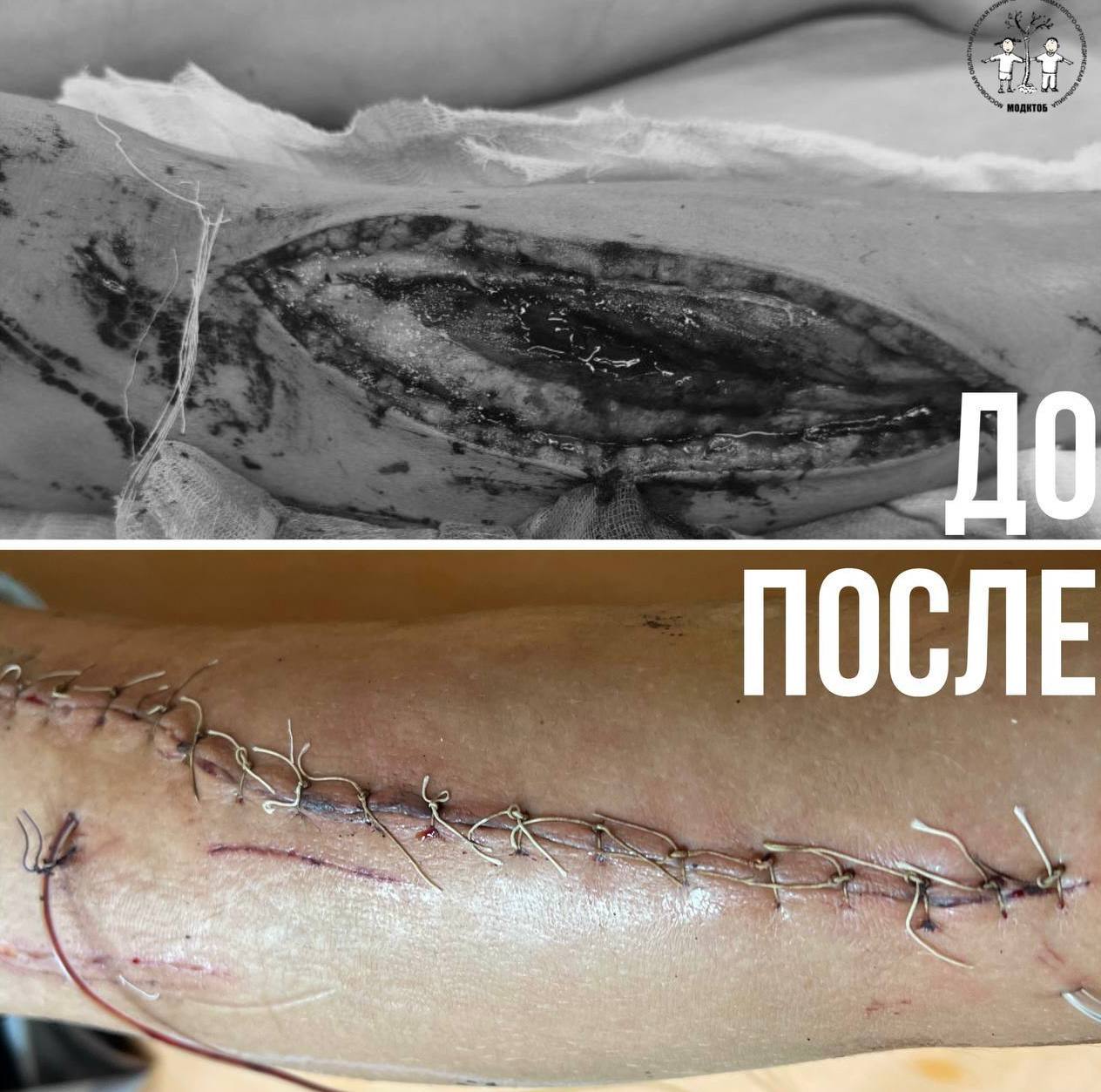 18+, фото не для слабонервных Врачи в Подмосковье спасли подростка, распоровшего ногу до кости мангалом В Московскую областную детскую клиническую травматолого-ортопедическую больницу на скорой привезли 13-летнего парня с зияющей раной на голени. Оказалось, что бегая на даче в высокой траве, он не заметил мангал и получил серьезнейшую травму. Медики провели хирургическую обработку раны, а после восстановили анатомию мягких тканей. Сейчас пострадавшего уже выписали на амбулаторное лечение. По словам специалистов, мальчик сможет полноценно наступать на ногу примерно через три недели.