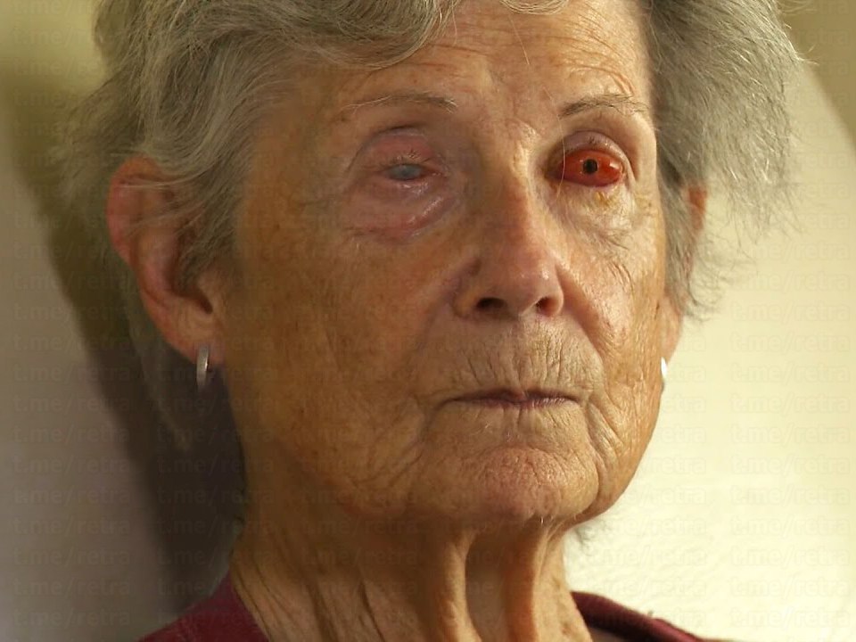 В Канаде женщине вставили зуб в глаз, чтобы она могла видеть  75-летняя Гейл Лейн полностью ослепла много лет назад из-за аутоиммунного заболевания, оставившего рубцы на роговицах её глаз.  Чтобы восстановить зрение, ей провели редчайшую операцию osteo-odonto keratoprosthesis  буквально «зуб в глаз» .  Сама операция максимально странная: — У пациентки извлекли собственный зуб; — Этот зуб вживили ей в щёку на несколько месяцев, чтобы он оброс соединительной тканью; — Затем в зубе просверлили отверстие и вставили в него миниатюрную оптическую линзу; — Получившийся биоимплант пересадили женщине в глаз, где он заменил повреждённую роговицу.  После операции зрение начало постепенно возвращаться: сначала Лейн увидела свет, потом — движение, затем контуры и цвета. Спустя месяцы она смогла разглядеть лица людей, включая лицо своего мужа, которого она никогда раньше не видела.  Какой-то проклятый биопанк r/#news