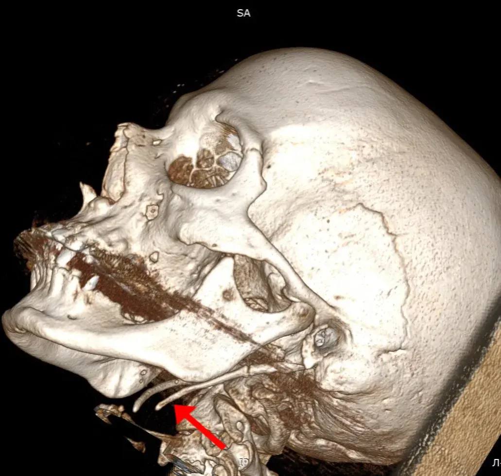 От костяной иглы избавили пациентку врачи хабаровской больницы С редкой патологией столкнулись медики в Краевой клинической больнице имени Сергеева Женщина долго страдала от болей и других болезненных проявлений а консервативное лечение не помогало Как поставили диагноз и что сделали врачи ЧИТАЙТЕ ЗДЕСЬ Фото ККБ имени профессора Владимирцева   AmurMedia Написать нам AmurMedia в Дзен