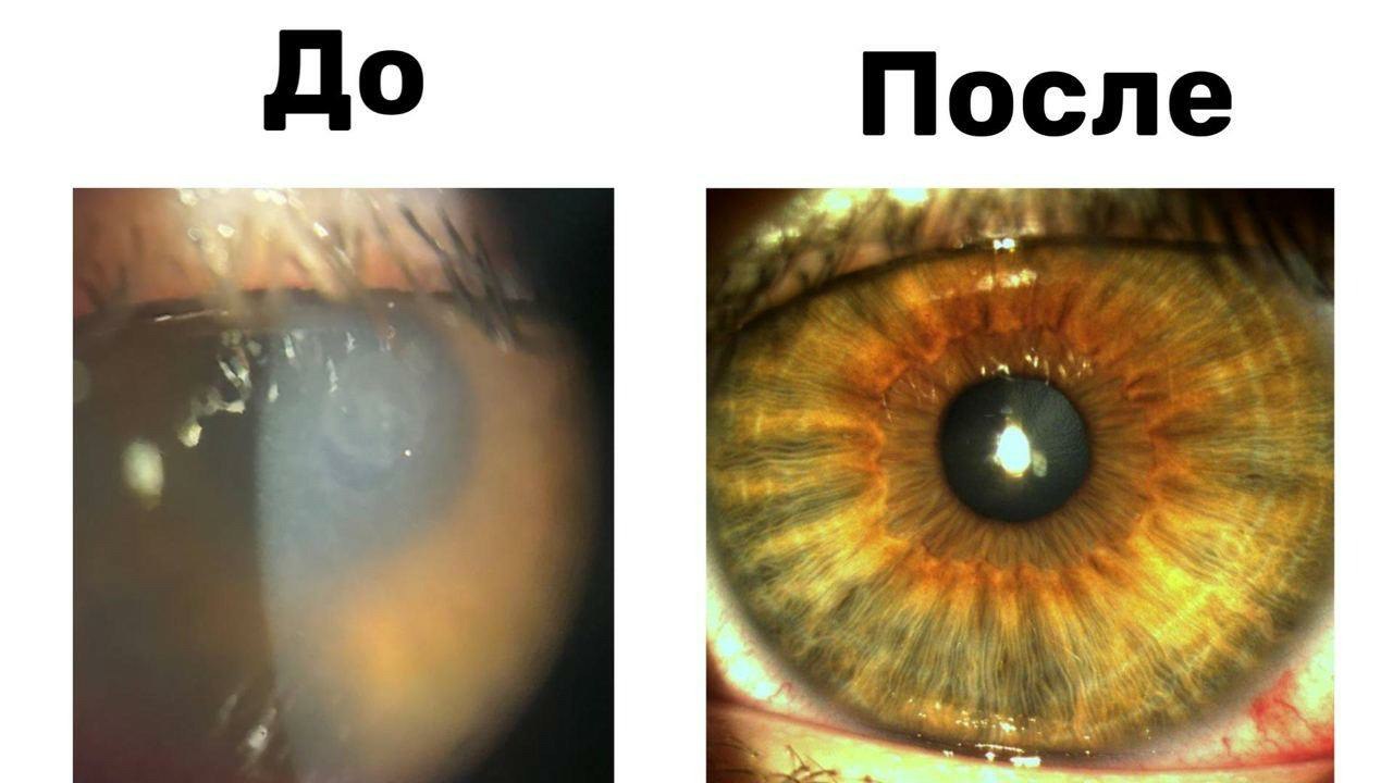 Врачи спасли зрение подростку, не снимавшему линзы три месяца  16-летний юноша жаловался на резкую боль в глазах, покраснение, слезотечение, отёк век и сильное помутнение зрения. Подросток рассказал, что в течение трёх месяцев носил, не снимая, линзы для ежедневной замены.   В левом глазу подростку диагностировали язву роговицы, а в правом — инородное тело в виде тканевой ворсинки. Об этом сообщили радиостанции «Говорит Москва» в Центре Рошаля.   «На фоне язвы был высокий риск перфорации и расплавления слоёв роговицы, что могло привести к тяжелому воспалению и даже слепоте», — рассказала офтальмолог Ксения Тараскова.   Подросток прошёл семидневное лечение и чувствует себя хорошо. В ближайшее время ему предстоит пройти реабилитацию и отказаться от контактных линз минимум на полгода.    Подпишись на «Говорит Москва»
