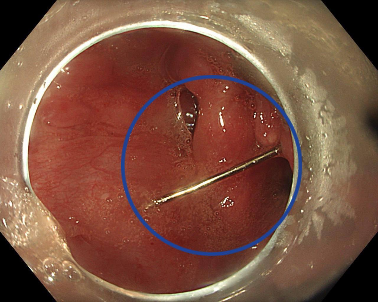 В Подмосковье 15 летняя девочка из любопытства проглотила иглу Родители сразу обратились за медицинской помощью Пациентку доставили в Детский научно клинический центр им Л М Рошаля с жалобами на сильную боль в горле рвоту с кровью и затрудненное глотание При обследовании врачи обнаружили инородное тело Операция прошла успешно и была проведена без единого разреза сообщил заведующий отделением эндоскопии Александр Иноземцев Подпишись на нас в МАХ