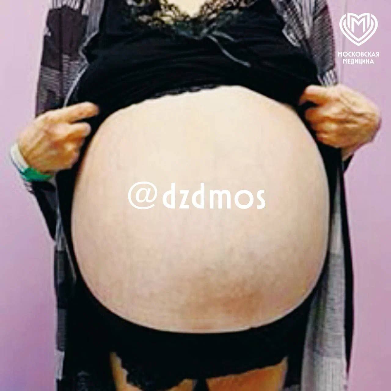 Это не большой живот а большая опухоль весом 30 кг Невероятную операцию провели врачи больницы имени Юдина удалить такое без вреда для пациентки крайне сложно Фото Департамента здравоохранения Москвы