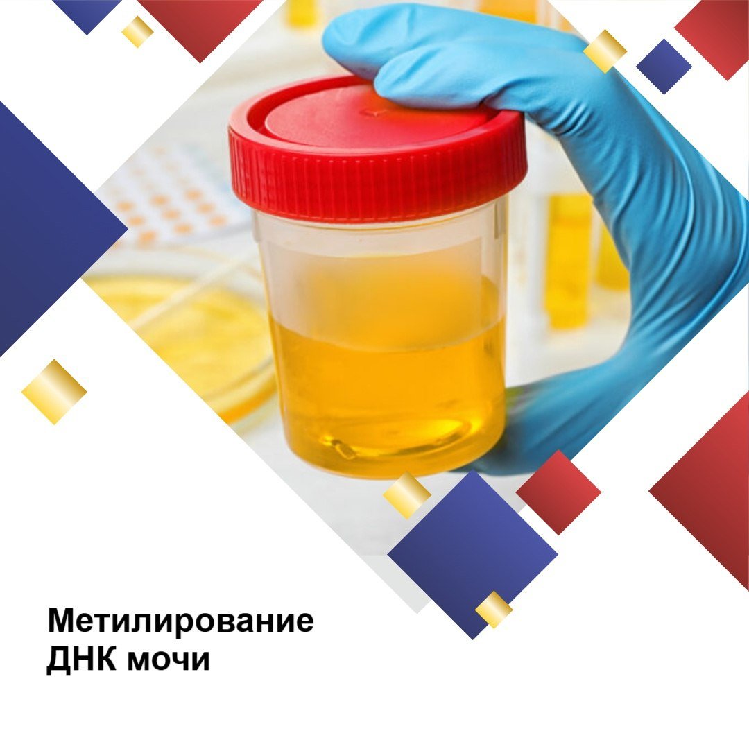 Новый метод диагностики рака мочевого пузыря   В журнале JAMA Oncology выложены результаты исследования южнокорейских ученых: тест на метилирование ДНК мочи оказался более чувствительным и специфичным по сравнению с традиционными методами.  В исследовании участвовали 1099 пациентов с гематурией. Для анализа метилирования ДНК, теста NMP22 и цитологического исследования у всех пациентов взяли образцы мочи:   Чувствительность нового метода  при раке высокой степени злокачественности  составила 89,2%, специфичность — 87,8%;  при любом раке мочевого пузыря — 78,1 и 88,8% соответственно;  тест достиг отрицательной прогностической ценности в 97,6%  высокая надежность в исключении рака мочевого пузыря высокой степени злокачественности или инвазивного рака .  Авторы отмечают недостаточно высокую положительную прогностическая ценность  61,3% .   С оригинальной статьей можно ознакомиться по ссылке: