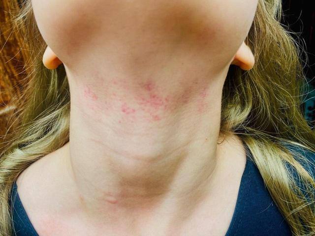 В лагере под Ишимом 15-летняя девочка пыталась задушить десятилетнюю  Мама пострадавшей рассказала, что дочь вернулась домой с синяками на шее и пожаловалась на боль. В школе подтвердили: подросток из коррекционного учреждения напала на младшую — загнала в угол и стала душить.  Родители написали заявление в полицию. Медики зафиксировали травмы, в школе — проверка. Нападавшая, по данным 72.ру, имеет психические особенности.