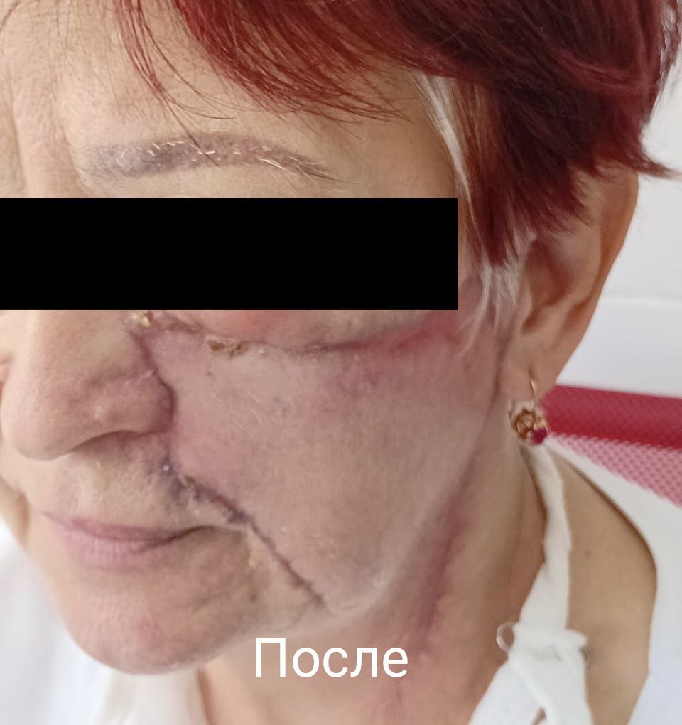 Огромную родинку на лице удалили пациентке ставропольские хирурги С такой родинкой женщина родилась и прожила до 68 лет, пока новообразование не начало её беспокоить. В последнее время родинка начала болеть, чесаться и расти. Женщина обратилась за помощью к врачам в отделение челюстно-лицевой хирургии Городской клинической больницы скорой помощи Ставрополя. Родинка занимала более 40% поверхности левой половины лица. В итоге ставропольчанку удалось полностью излечить. Как сообщили в "Скорой", женщина захотела поделиться своей историей, чтобы помочь другим людям, столкнувшимся с этой проблемой. Специалисты напоминают, что если вы столкнулись с чем-то подобным и родинка начала себя подозрительно вести — не откладывайте и бегите к врачам. В курсе Новости Ставрополья предложить новость