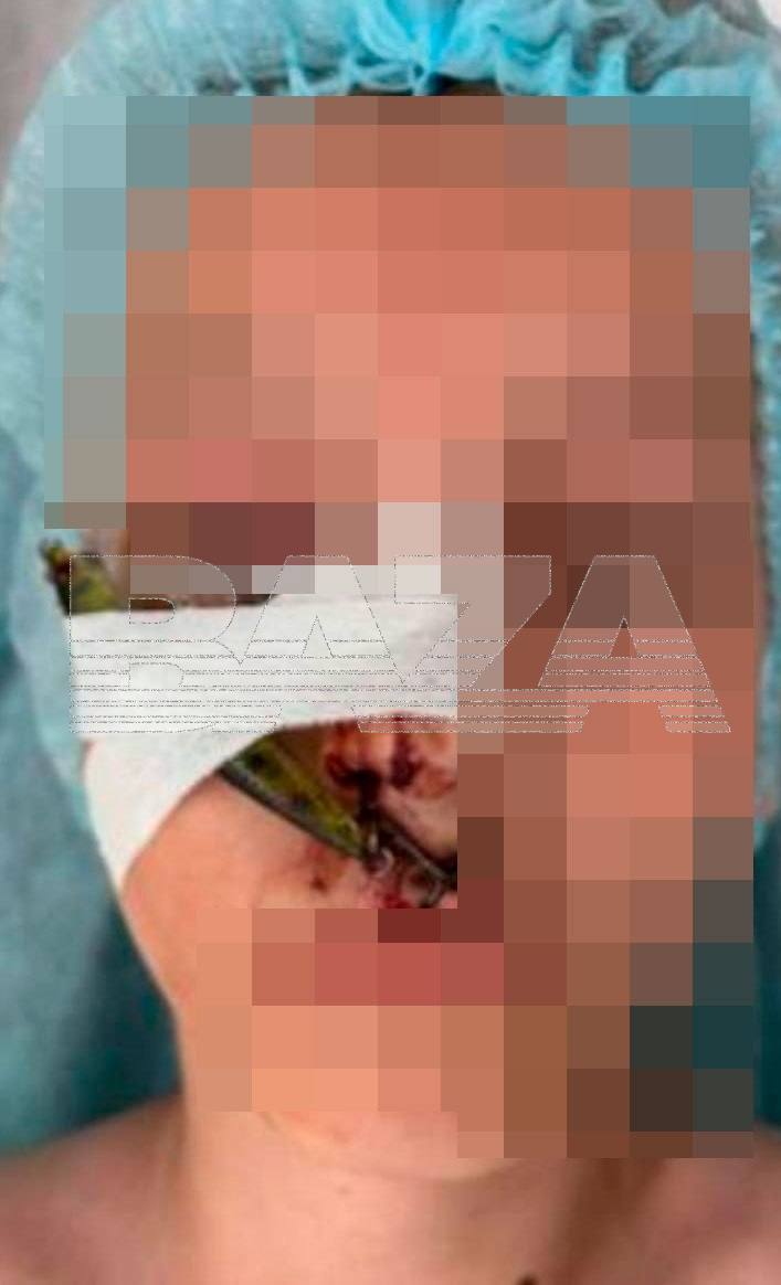 В Подмосковье парень пошёл на леща и поймал сам себя.   10-летний мальчик поступил в Детский клинический центр им. Л.М. Рошаля с необычной травмой: рыболовный воблер зацепил ему губу, нос, а также верхнее и нижнее веки. Парень не рассчитал силы и слишком энергично закинул удочку.   К счастью для мальчика, воблер не задел глазное яблоко. Благодаря слаженной работе офтальмохирургов и челюстно-лицевых хирургов парня удалось освободить от воблера — сейчас здоровью пацана ничего не угрожает.  Ловля на живца.    Подписывайтесь, это Baza