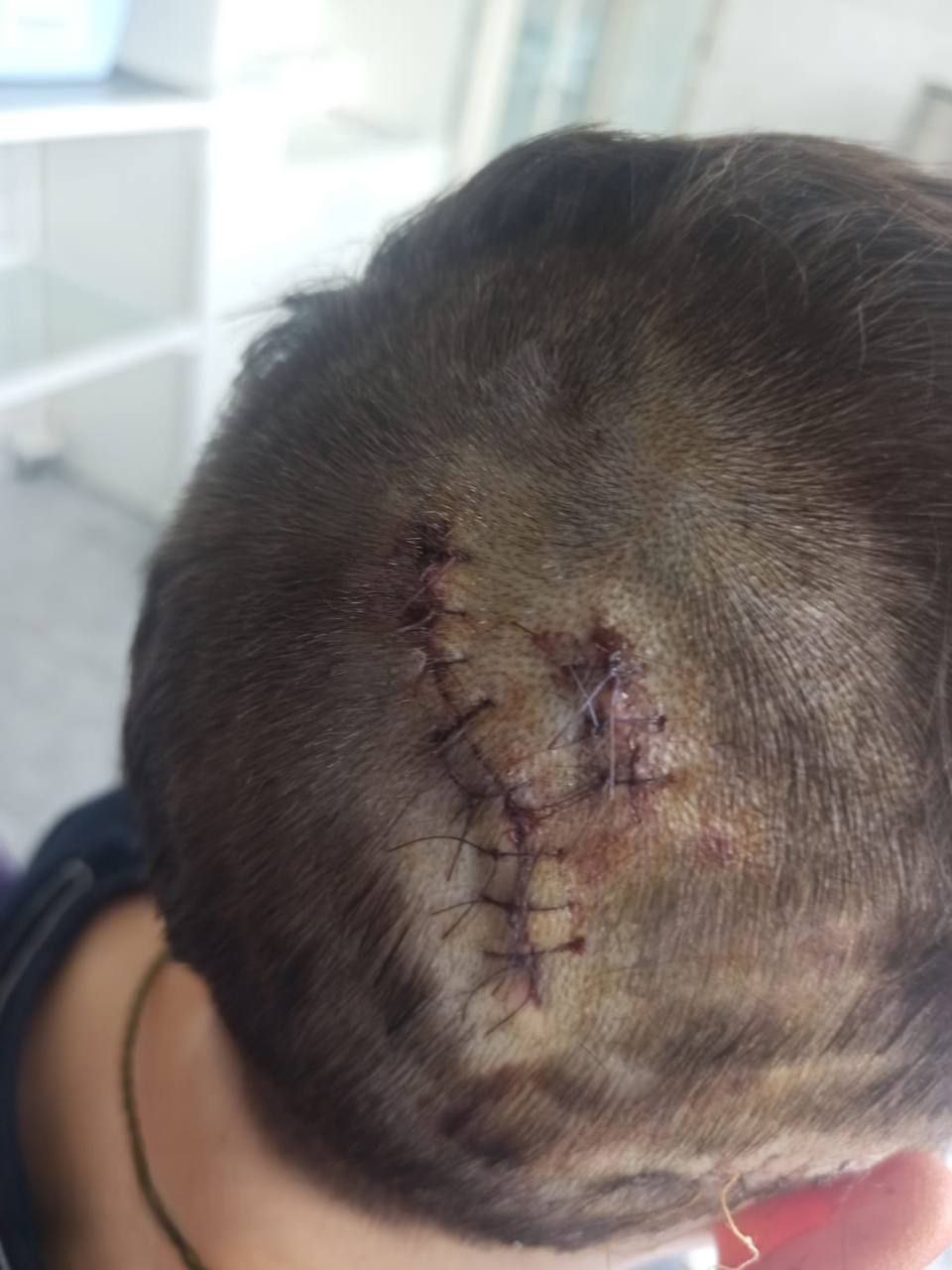 Домашняя собачка практически сняла скальп со своего маленького хозяина — она впилась мальчику в голову К счастью, его спасли в Московском областном центре материнства и детства. 1 Подпишись Поделись новостью