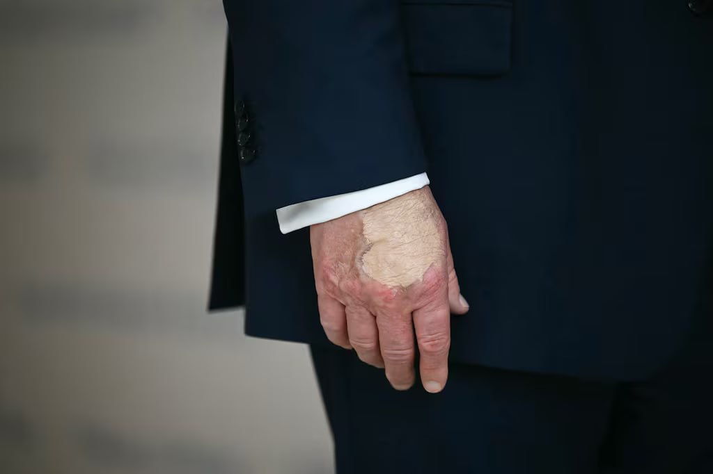 На руке у Дональда Трампа вновь увидели синяк который президент США попытался скрыть тональным кремом Как пишет Daily Beast после возвращения в Белый дом Трамп регулярно использовал косметику чтобы скрыть синяк на правой руке По словам его пресс секретаря у американского президента выявили хроническую венозную недостаточность а синяки появляются из за частых рукопожатий newsprav da