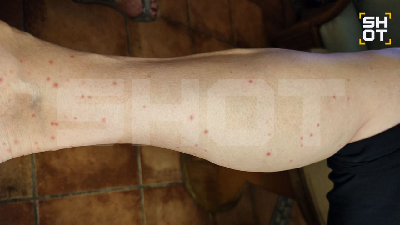 Российские туристы в Египте начали массово жаловаться на нашествие клопов в отелях Кровососущих насекомых обнаружили в четырёх и пятизвёздочных гостиницах Шарм эль Шейха Хургады и Сахль Хашиша Сначала путешественники заметили на своём теле странные укусы но не придали этому серьёзного значения Спустя время чёрных насекомых нашли в кроватях пишет Telegram канал SHOT Как рассказали отдыхающие их дважды переселяли в другие номера но и там жильцов поджидали клопы Некоторые турагенты уже назвали ситуацию с насекомыми в Египте эпидемией столько жалоб на кровососущих по их словам не получали десять лет Россияне опасаются что клопы могут пробраться в чемоданы и вместе с ними улететь домой Подписаться на Говорит Москва Telegram VK MAX