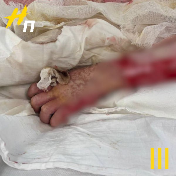 15 летняя девочка покурила вейп теперь ей нужна пластическая операция Девочка из Петербурга покурила вейп в переходе и чуть не умерла У неё начался токсический некролиз это сильная сыпь при которой начинает слезать кожа Ей удалось выжить но тело покрылось язвами от ран Теперь подростку нужна пластическая операция В то же время в Госдуме предложили ввести уголовную ответственность за изготовление хранение распространение и использование вейпов Официальное обращение уже направлено в МВД Инициаторы отмечают что вопрос не только в борьбе с зависимостью но и в культурном выборе общества Законотворцы хотят поставить точку в этой теме и защитить будущее поколение от разрушительных привычек если поддерживаете такую меру если считаете что это через чур Новый Петербург в МАХ