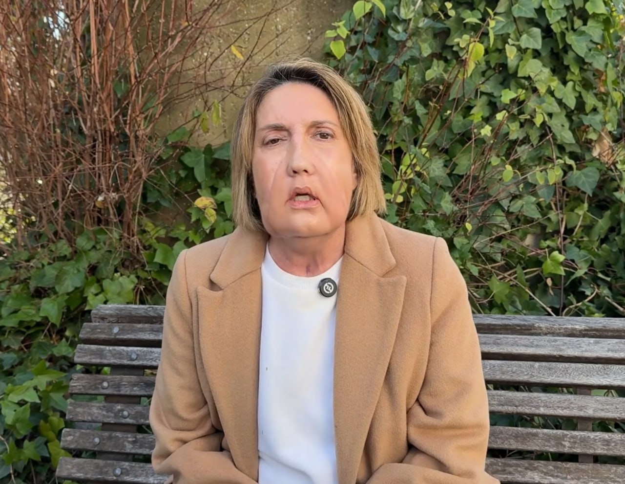 В Испании провели первую в мире пересадку лица от донора после эвтаназии Трансплантация центральной части лица потребовалась пациентке у которой был ранее выявлен некроз тканей спровоцированный бактериальной инфекцией В этой операции приняли участие около ста специалистов представляющих разные направления включая пластических хирургов анестезиологов иммунологов и психиатров сообщили на официальном сайте клиники Vall d Hebron После операции пациентка провела в клинике месяц где врачи наблюдали за ее состоянием а также помогали поскорее принять изменения во внешности Сейчас женщина продолжает работу над восстановлением жизненно важных функций мимики и речи Отмечается сам донор решивший добровольно завершить жизнь при помощи эвтаназии заранее выразил желание пожертвовать не только органы но и лицо нуждающимся в трансплантации пациентам Подписаться на truekpru Читать нас в MAX