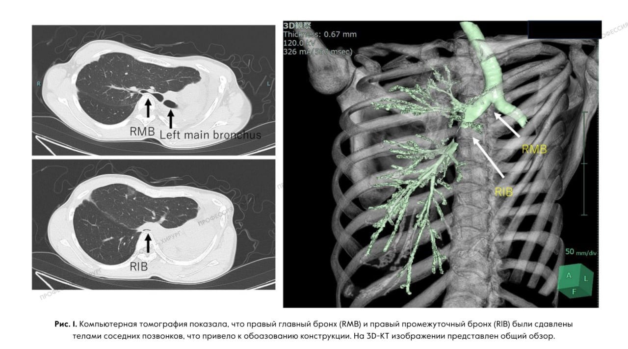Клинический случай  36-летняя женщина перенесла пневмонэктомию слева по поводу немелкоклеточного рака легкого после химиолучевой терапии. Патологоанатомическое обследование выявило аденокарциному ypT2aN0M0 IB стадии.   Впоследствии пациентка получила адъювантную химиотерапию урацилом с последующим наблюдением пульмонолога. Через два года и 1 месяц после операции у пациентки появилась одышка. В связи с этим она направлена на госпитализацию для дальнейшего обследования у врач-пульмонолога.   Компьютерная томография выявила сильное смещение средостения, обструкцию правого главного и правого нижнего бронхов  рис. 1 . Левая грудная полость, ранее свободная, больше не существовала, так как поверхность перикарда соединилась с париетальной плеврой.   Рентген также показал, что левая часть грудной полости почти исчезла из-за смещения средостения, и во время торакотомии ожидался лишь небольшой промежуток между грудной стенкой и перикардом  рис. 2 . Перфузионное сканирование выявило полный дефект правой нижней доли  рис. 3 .   На основании этих результатов дыхательная недостаточность была вызвана обструкцией дыхательных путей. Несмотря на проведение неинвазивной вентиляции легких с положительным давлением для насыщения кислородом, состояние дыхания пациентки еще больше ухудшилось.  Проведена экстренная операция из-за тяжелой дыхательной недостаточности. Сердечно-сосудистые хирурги готовились к вено-венозному анастомозу. Выполнена экстракорпоральная мембранная оксигенация  ЭКМО  и установлены катетеры, а анестезиологи обеспечивали респираторную поддержку.
