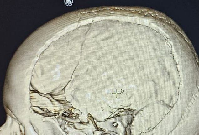 Орловские хирурги спасли ребенка с редким сосудистым поражением мозга Как сообщает департамент здравоохранения Орловской области в НКМЦ им З И Круглой успешно проведена экстренная операция 13 летнему пациенту с врожденной патологией сосудов головного мозга Ребенок поступил в крайне тяжелом угрожающем жизни состоянии   www infoorel ru news orlovskie hirurgi spasli rebenka s redkim sosudistym porazheniem mozga html