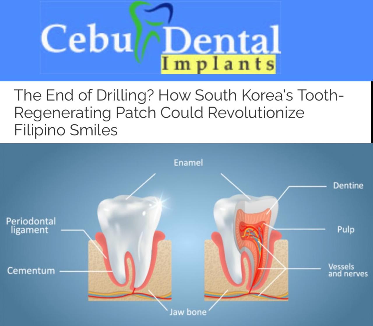 Конец эры сверления В Корее придумали пластырь который помогает зубам наращивать поврежденные участки Южнокорейским исследователям удалось масштабировать технологию которая способна перевернуть представление о восстановлении зубов Суть заключается в биорастворимом пластыре насыщенном специальными белками и молекулами например пептидами После бережной очистки кариозного участка стоматолог накладывает сверхтонкий пластырь прямо на повреждение Пластырь постепенно выделяет биоактивные молекулы которые проникают в структуру зуба и пробуждают стволовые клетки естественным образом присутствующие в пульпе Активированные клетки начинают регенерировать дентин твёрдую ткань под эмалью Кариес заполняется изнутри живой тканью самого пациента Подпишись на ПУЛ N3
