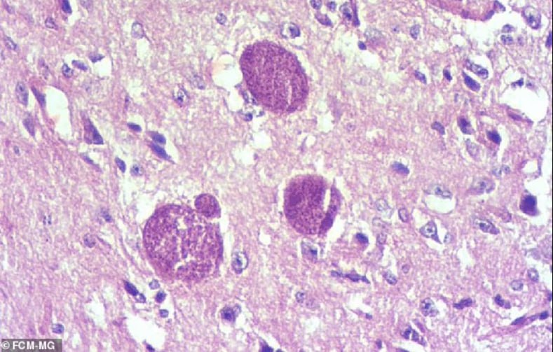 Паразит, скрыто разрушающий мозг: учёные нашли способ его выявить Toxoplasma gondii десятилетиями живёт в мозге, меняя поведение человека. Учёные из Калифорнийского университета обнаружили, что заражённые клетки выделяют меньше внеклеточных везикул ВВ — частиц, участвующих в передаче сигналов между нейронами. Эти частицы можно обнаружить в крови, и если связь подтвердится, ВВ станут маркером скрытой инфекции. Паразит попадает в организм через плохо прожаренное мясо или кошачьи экскременты. В мозге он может оставаться в «спящем» состоянии десятки лет. Обычно инфекция протекает бессимптомно, но иногда вызывает температуру, слабость и спутанность сознания. У людей с ослабленным иммунитетом возможны судороги и проблемы с дыханием. По оценкам, в США заражены 10–30% населения, и большинство об этом не знает. Ранняя диагностика могла бы спасти миллионы людей.