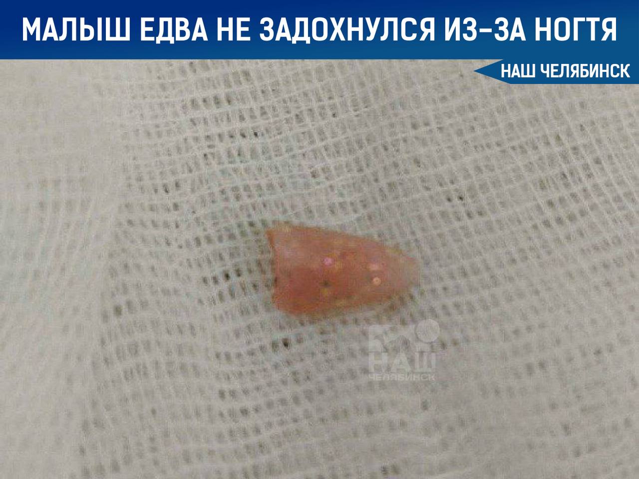 В Челябинске врачи спасли малыша подавившегося ногтем 10 месячный ребёнок задыхался Сначала предполагалось что он подавился собачьим кормом Во время операции медики обнаружили в дыхательных путях твёрдый предмет Оказалось что это наращенный ноготь Его удалось аккуратно извлечь с помощью специального оборудования После операции малыш провёл ночь в реанимации сейчас его состояние стабильное Мы в ТГ ВК ОК MAX Не пропустите важные новости