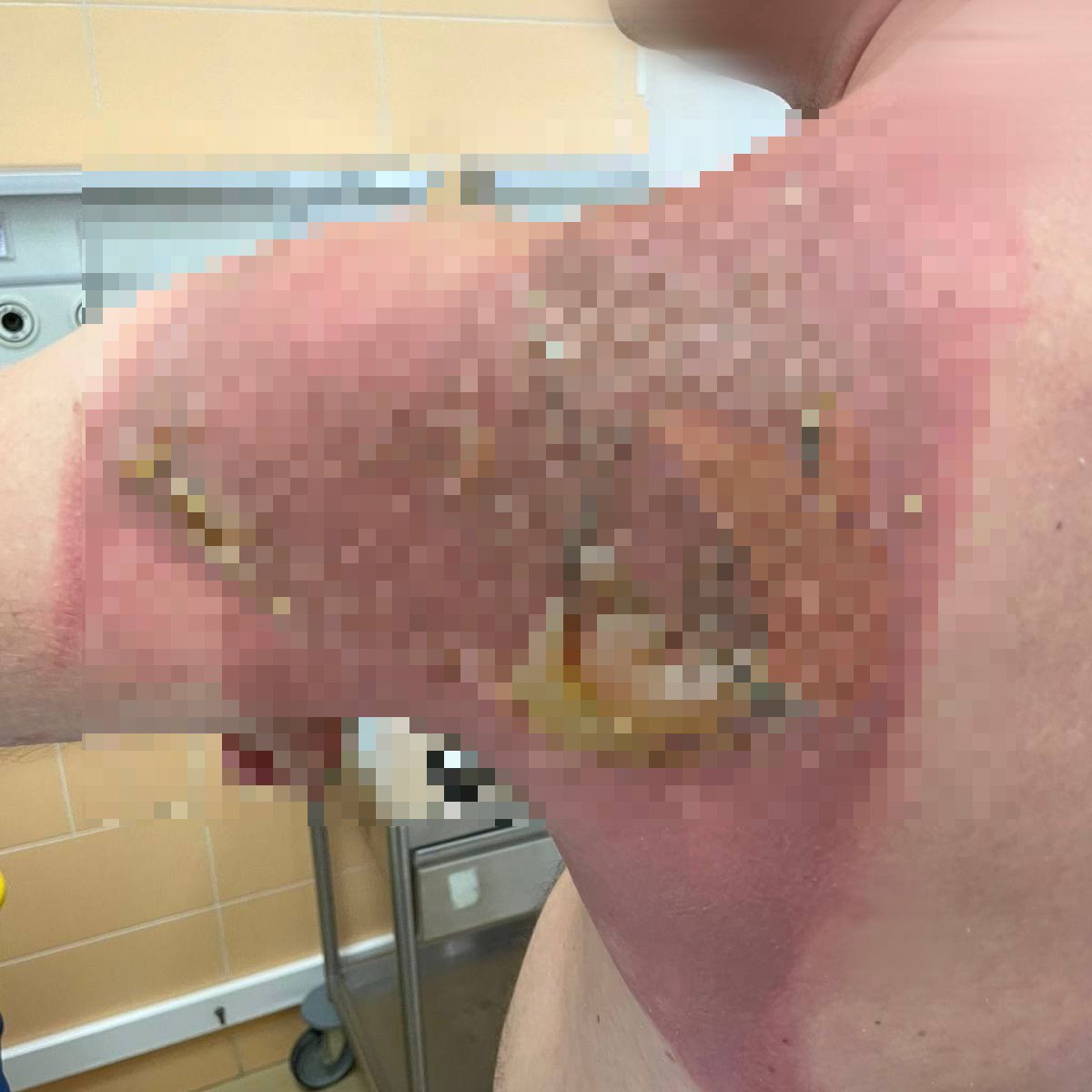 Житель Татарстана сжег спину до волдырей во время сна Причина постиранное постельное белье азиатскими капсулами приобретенными на маркетплейсе 26 летний пациент получил ожоги 1 2 степени сообщили в РКБ Татарстана Медики обработали рану и отпустили его домой По словам мужчины жена постирала постельное белье а на утро он проснулся с ожогом Никаких кремов пострадавший не использовал сообщили РЕН ТВ в РКБ по республике РЕН ТВ в Telegram в MAX