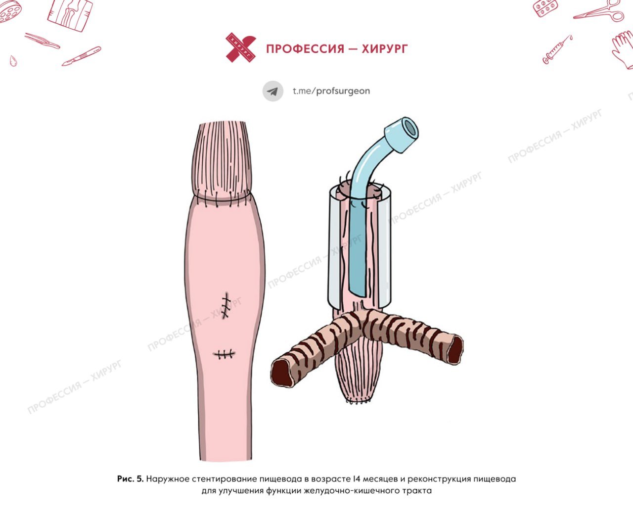 Клинический случай. Продолжение  Абдоминальное бандажирование пищевода и гастростомия выполнены через 7 ч после рождения  рис. 2 . После операции вентиляция легких под положительным давлением через трахеопищеводный свищ стабилизировала его дыхательное состояние.   Однако опасения по поводу аспирационной пневмонии требуют дальнейшего лечения дыхательных путей, а надлежащее лечение дыхательных путей обеспечивает долгосрочную выживаемость.  Вторая операция  рис. 3  проведена на 15-й день после рождения. Сделан горизонтальный разрез кожи над грудинной вырезкой, и шейный отдел пищевода был пересечен на средней высоте шеи.   Проксимальная шейная эзофагостомия выполнена с правой стороны, а дистальная шейная эзофагостомия — для псевдотрахеостомии по средней линии. В дистальный отдел шейного отдела пищевода вставлен инструмент AdjustFit Neo 3,5 мм  Fuji Systems, Токио, Япония .   Несмотря на эти усилия, его дыхательная стабильность была нарушена по мере увеличения веса из-за коллапса трахеализированного пищевода и узкого диаметра трахеопищеводного свища. Попытки ввести трубку в трахеопищеводный свищ оказались затруднены из-за того, что его отверстие было похоже на крошечное отверстие  рис. 4 .   В результате изготовлена специальная трахеальная трубка, соответствующая анатомии дыхательных путей пациента в возрасте 10 месяцев. Его кончик располагался непосредственно над трахеопищеводным свищом для внутреннего стентирования пищеводных дыхательных путей и предотвращения коллапса.   После стабилизации дыхательных путей трахеализированный пищевод удлиняется при вентиляции с положительным давлением, что со временем приводит к нестабильности фиксированной трубки и нарушению вентиляции.