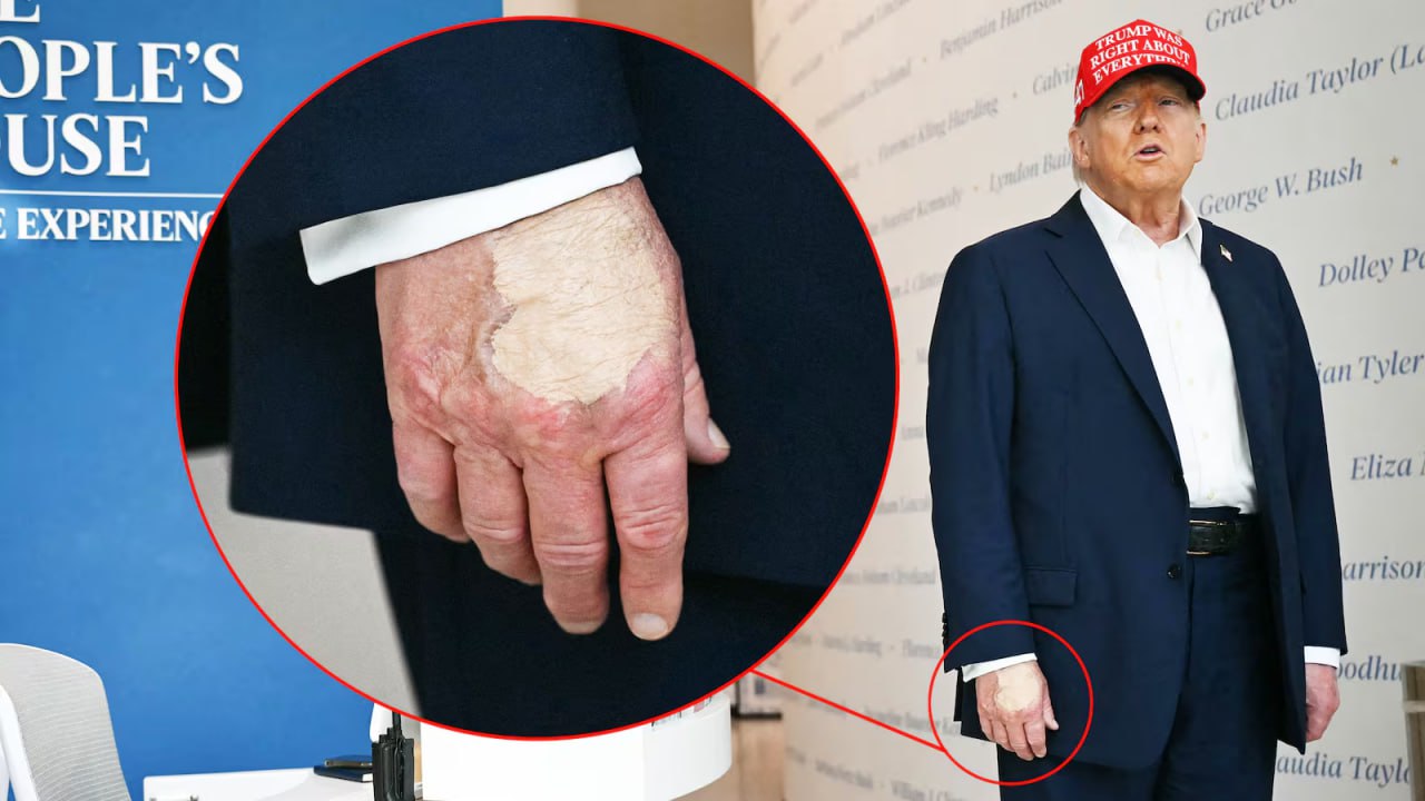 Трамп вновь оказался в центре обсуждений из за состояния здоровья Президент США Дональд Трамп вновь привлёк внимание СМИ после появления на публике с заметным слоем тонального крема на руке Как сообщает The Daily Beast макияж по версии прессы использовался для маскировки синяков kun uz ru 36896446 Официальные страницы Kun uz Telegram Facebook Instagram Youtube